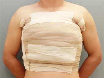 女性化乳房修正術症例№08手術直後固定正面