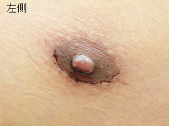 女性化乳房修正術症例№08手術後１週間左乳輪部
