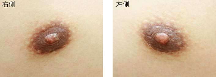 女性化乳房修正術症例№08手術後３ヶ月乳輪部