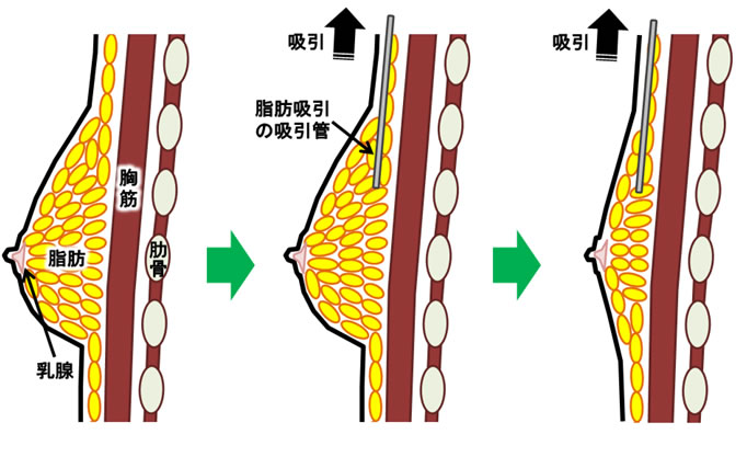 女性化乳房手術方法のイメージ１