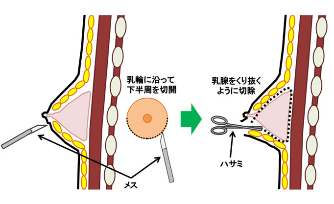 女性化乳房手術方法のイメージ４
