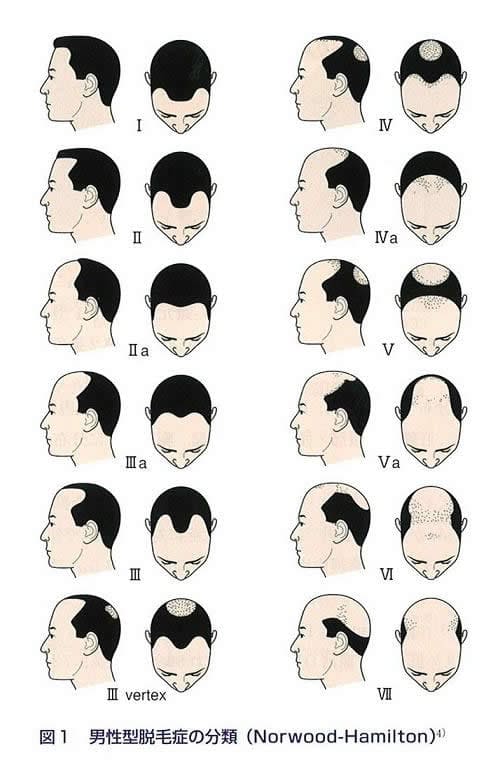 男性型脱毛症の分類