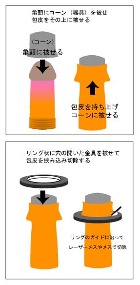 クランプ法による包茎手術