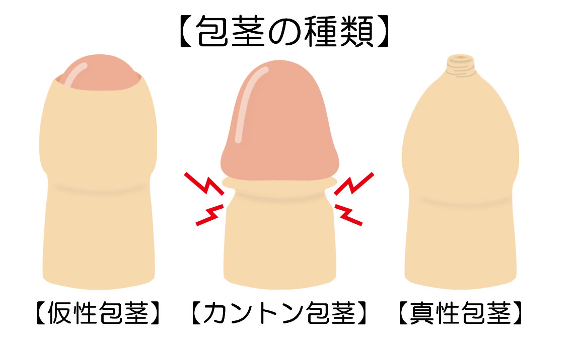 包茎の種類