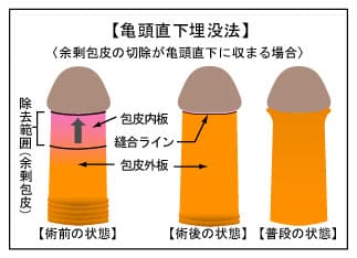 亀頭直下埋没法による包茎手術