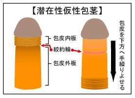 潜在的包茎