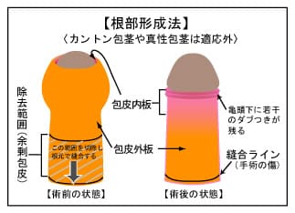 根部形成による包茎手術図