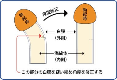 屈曲ペニス湾曲ペニスの薄膜修正
