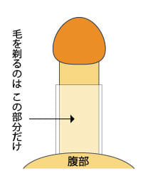 屈曲ペニス湾曲ペニス手術時の剃毛範囲