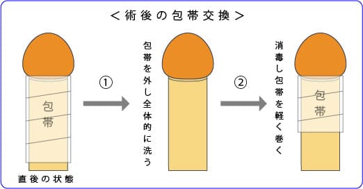 屈曲ペニス湾曲ペニスの手術後の包帯交換