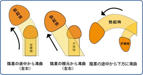 屈曲ペニス湾曲ペニスのタイプ、種類