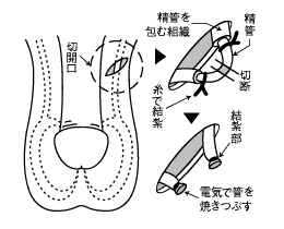 パイプカットの手術方法の図解